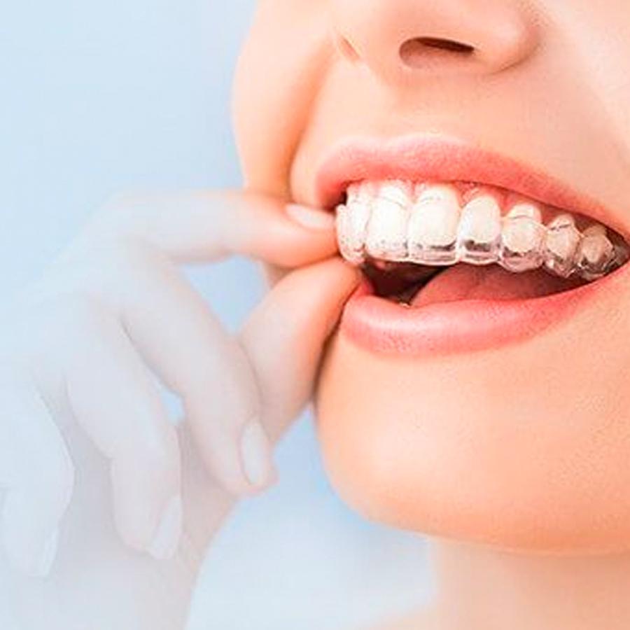 orthodontic clear aligners in Lake Forest, CA Orange County